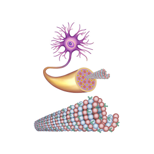 neurona y ovillos neurofibrilares