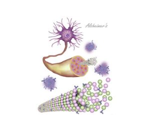 alteración neuronal en alzheimer
