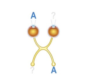 amblyopia