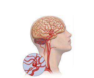 aneurisma cerebral