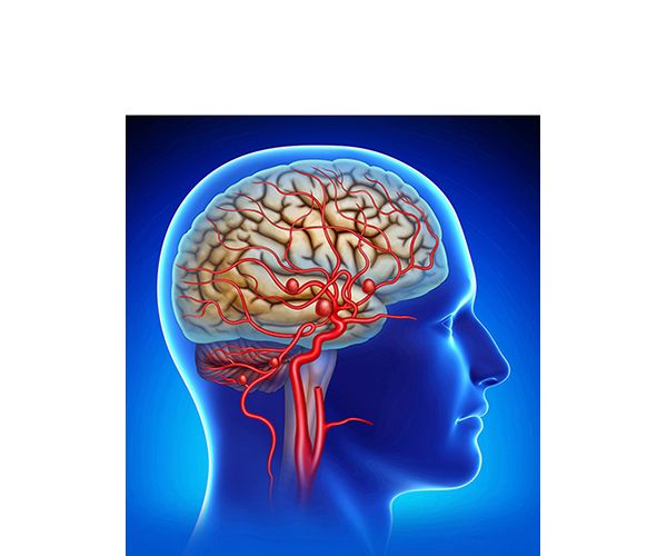 aneurisma cerebral azul aneurisma cerebral azul