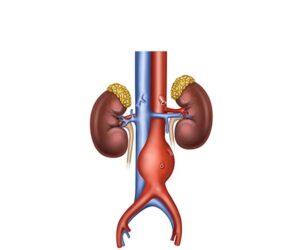 aneurismas aorta abdominal fusiforme