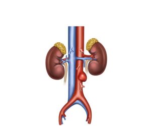 aneurismas aorta abdominal sacular
