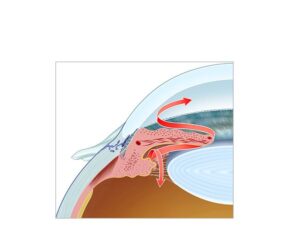 aqueous drainage in glaucoma