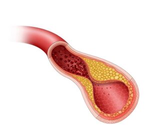 arteria y colesterol avanzada