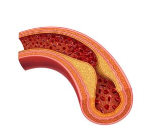 arteria y colesterol avanzado