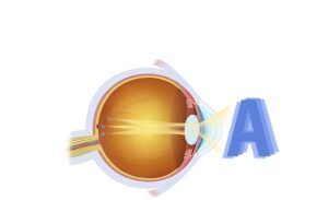 astigmatismo