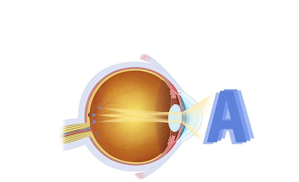 astigmatismo astigmatismo