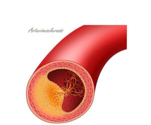 atherosclerosis ruptura