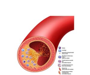 atherosclerosis ruptura analisis