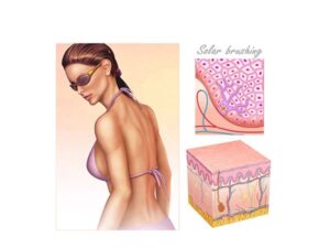 bronceado y rayos solares