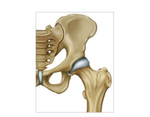 cadera cabeza femur