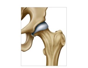 cadera y cabeza del femur