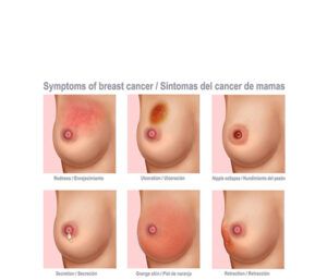 cambios de mamas por cáncer