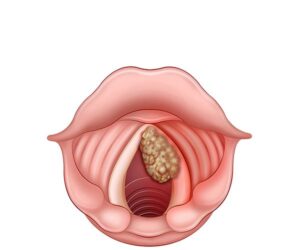 cancer de las cuerdas vocales