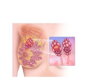 cancer lobular de mamas