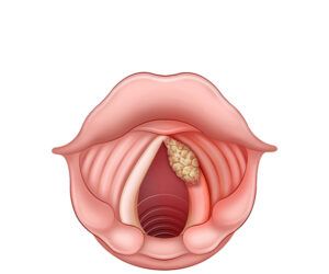 carcinoma de las cuerdas vocales