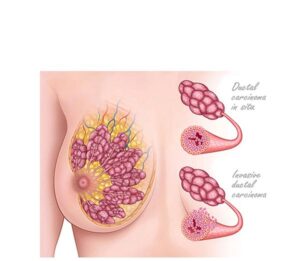 carcinoma ductal de las mamas