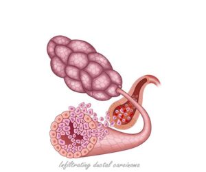 carcinoma ductal invasivo
