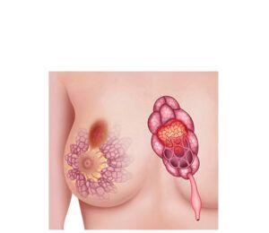 carcinoma mamario