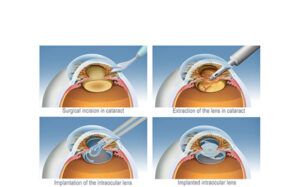 cataract surgery process