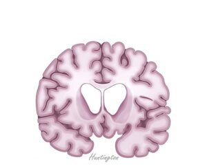 cerebro en la enfermedad de huntington