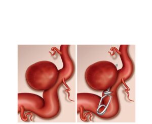 clipaje de aneurisma cerebral