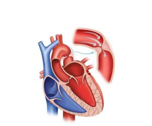 coartación aórtica de corazón