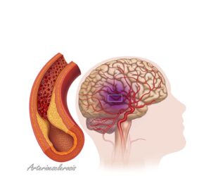 colesterol en arterias cerebrales