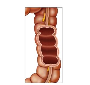 colon descendente