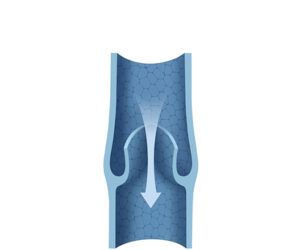 defective venous valve