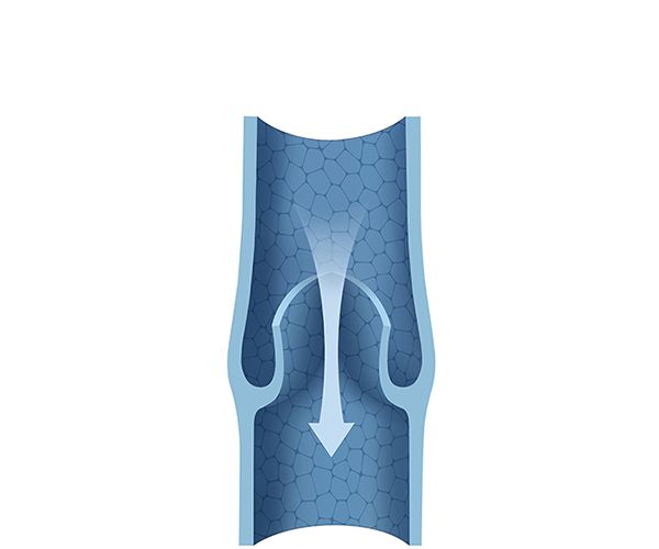 defective venous valve defective venous valve
