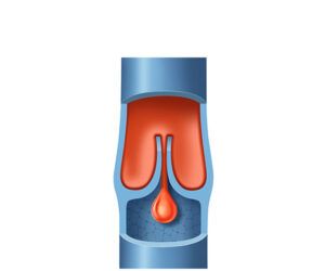 defective venous valves