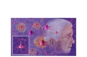 deterioro neuronal en alzheimer