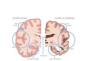 diferencias cerebrales en alzheimer
