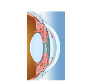 drenaje humor en glaucoma