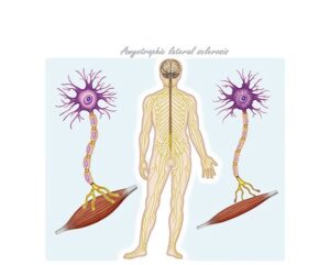 ela, esclerosis lateral amiotrófica