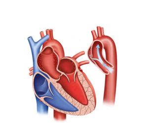 el corazón neurisma aortico