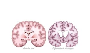 enfermadad de huntington