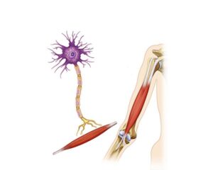 esclerosis lateral