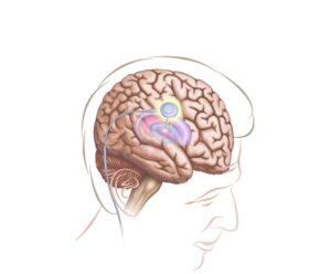 estimulador cerebral en parkinson
