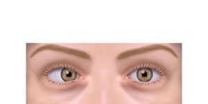 estrabismo esotropia