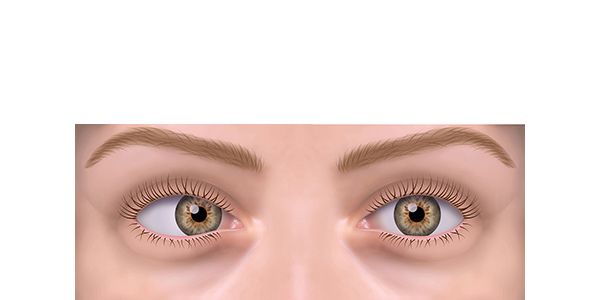 estrabismo esotropia estrabismo esotropia
