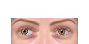 estrabismo exotropia