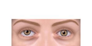 estrabismo hipertropia