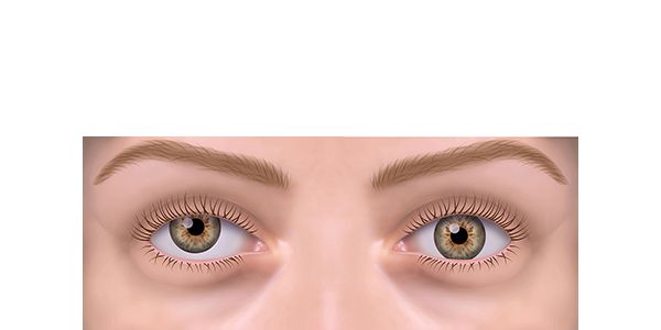 estrabismo hipertropia estrabismo hipertropia