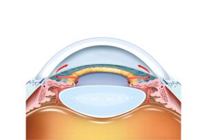eye with glaucoma