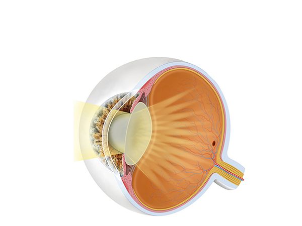 focusing the eye with cataract focusing the eye with cataract