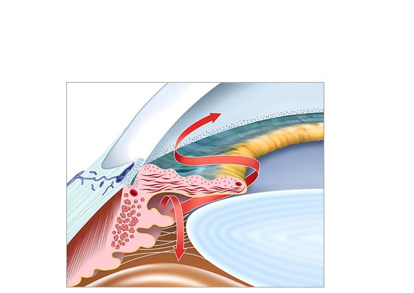 glaucoma glaucoma