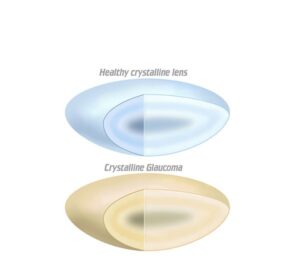 healthy lens with cataracts